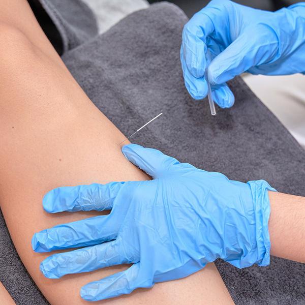 dry needling therapy for pain relief near SOHO NYC